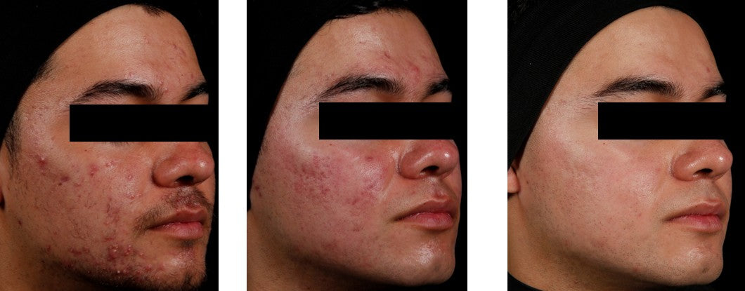 AviClear Protocole Anti Acné
